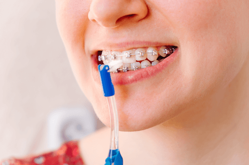 braces as an investment
